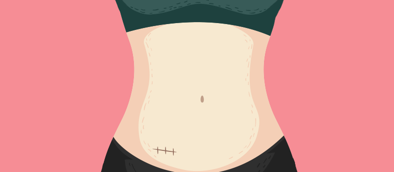 cartoon stomach with stitches on the bottom left corner