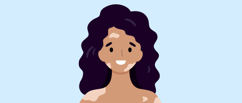 A cartoon of a woman using tacrolimus ointment for vitiligo.